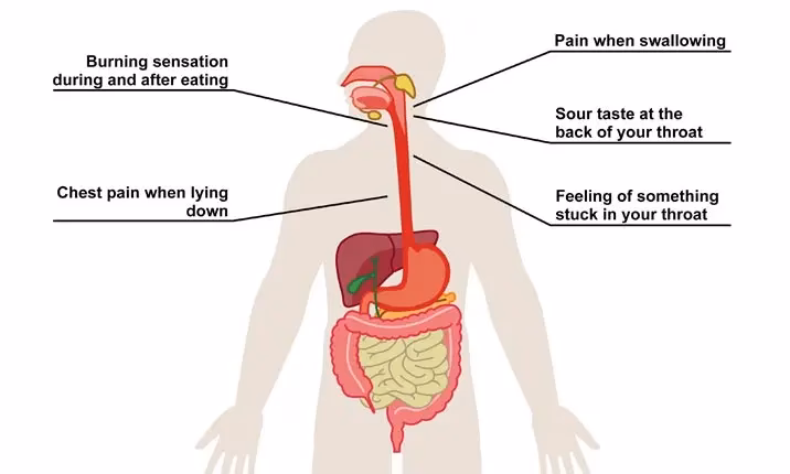 Can anxiety cause acid reflux?