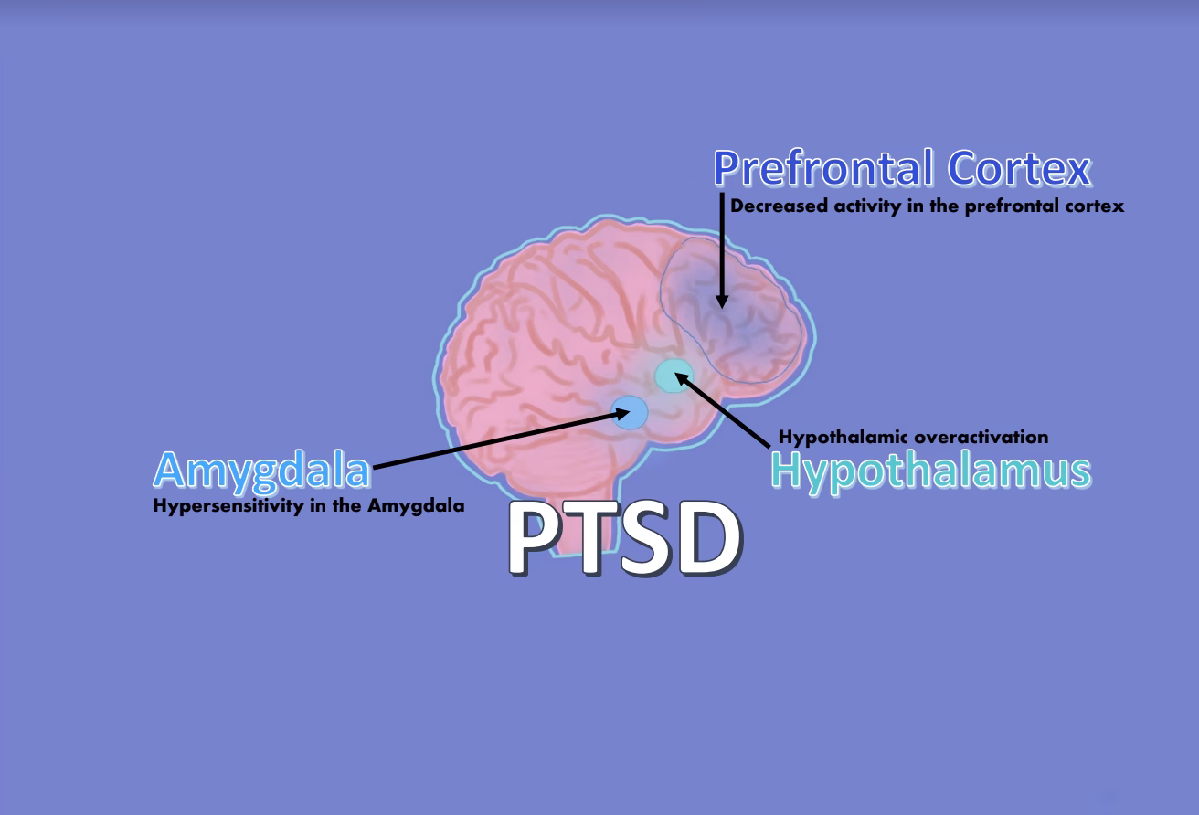 What is the connection between amygdala dysfunction and heightened fear responses in PTSD?