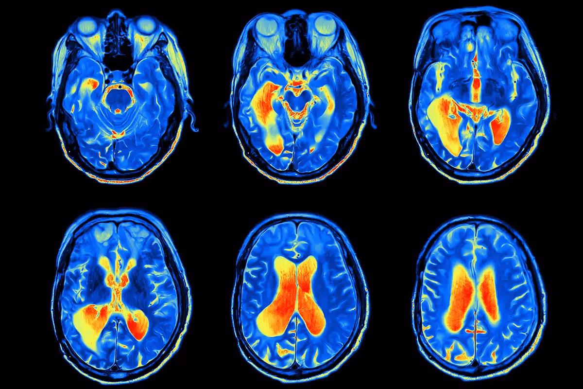 Does chronic stress affect brain plasticity and cognitive function?