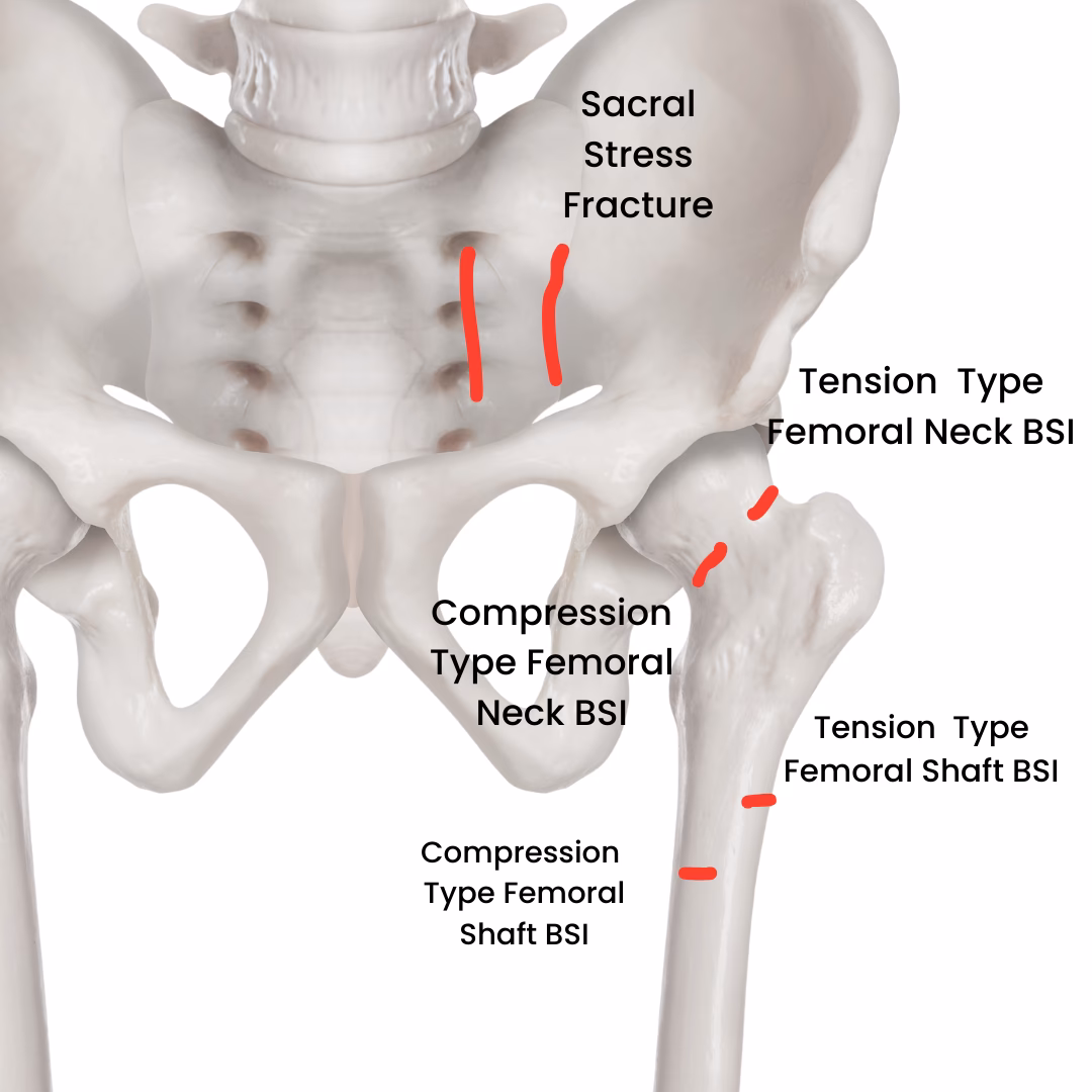 Who is at risk for a stress fracture in the hip?
