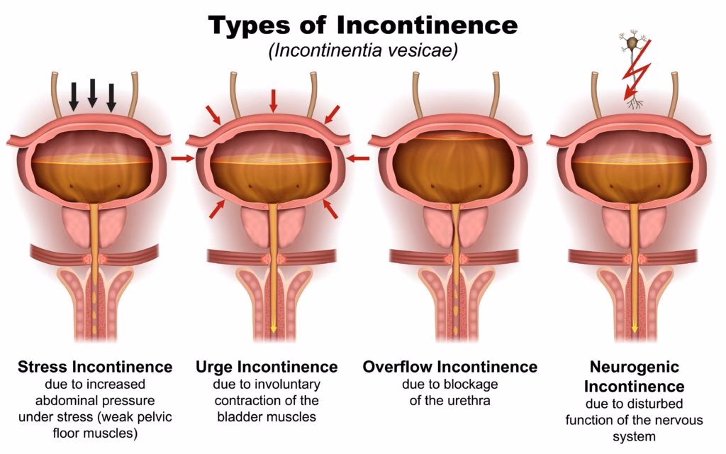 What is stress urinary incontinence (SUI)?