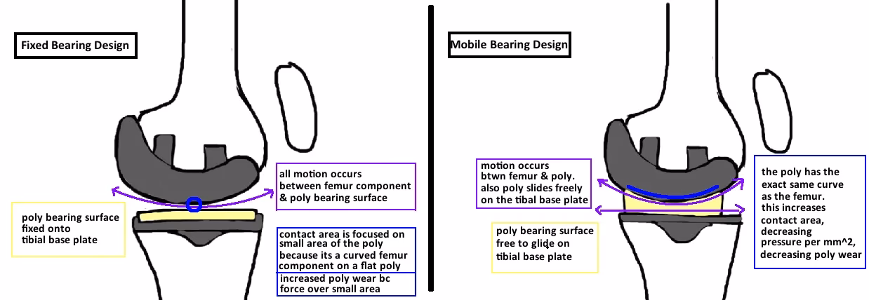Do mobile-bearing tkrs increase congruity and mobility?