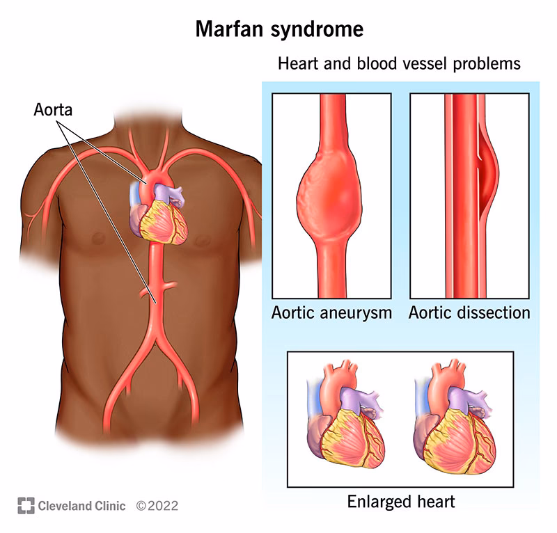 Should psychological and neuropsychological domains be assessed in Marfan syndrome patients?