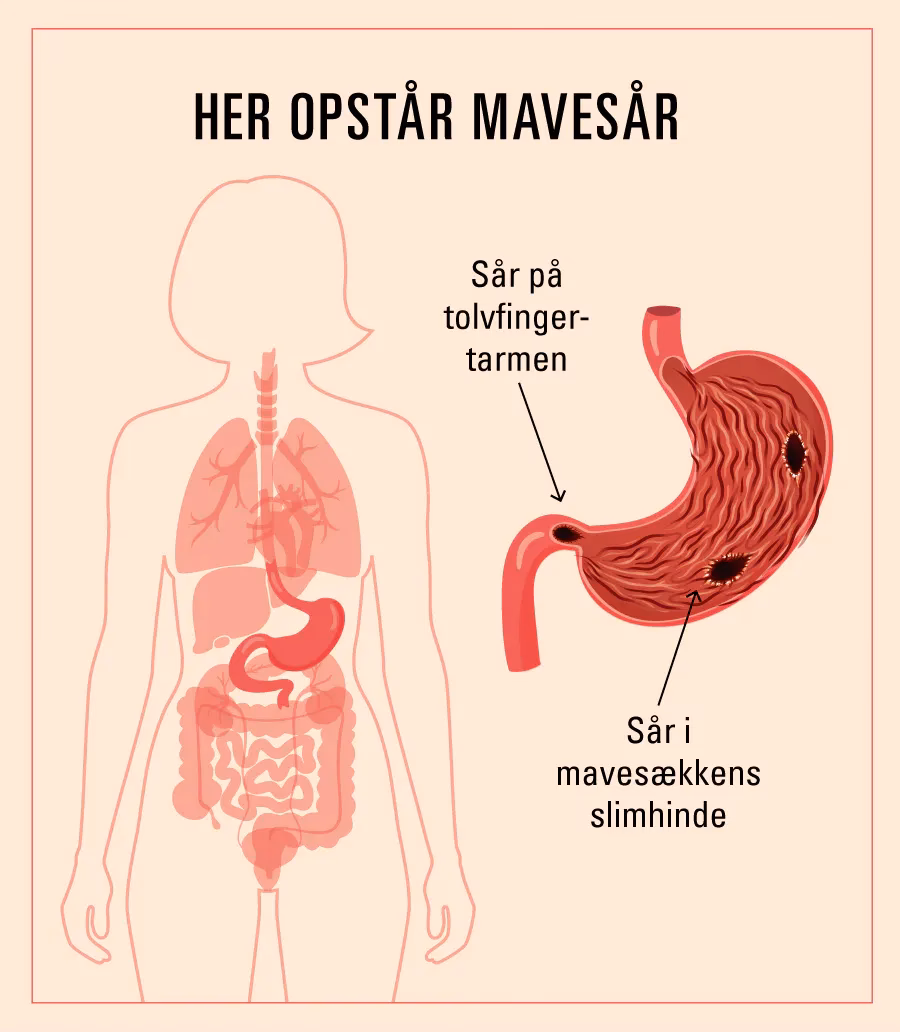 Hvad er årsagen til mavesår?