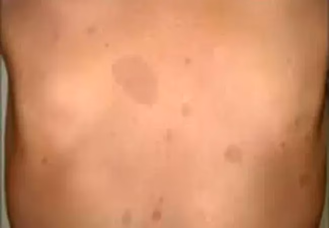 Is neurofibromatosis type 1 a single-gene model for autism?