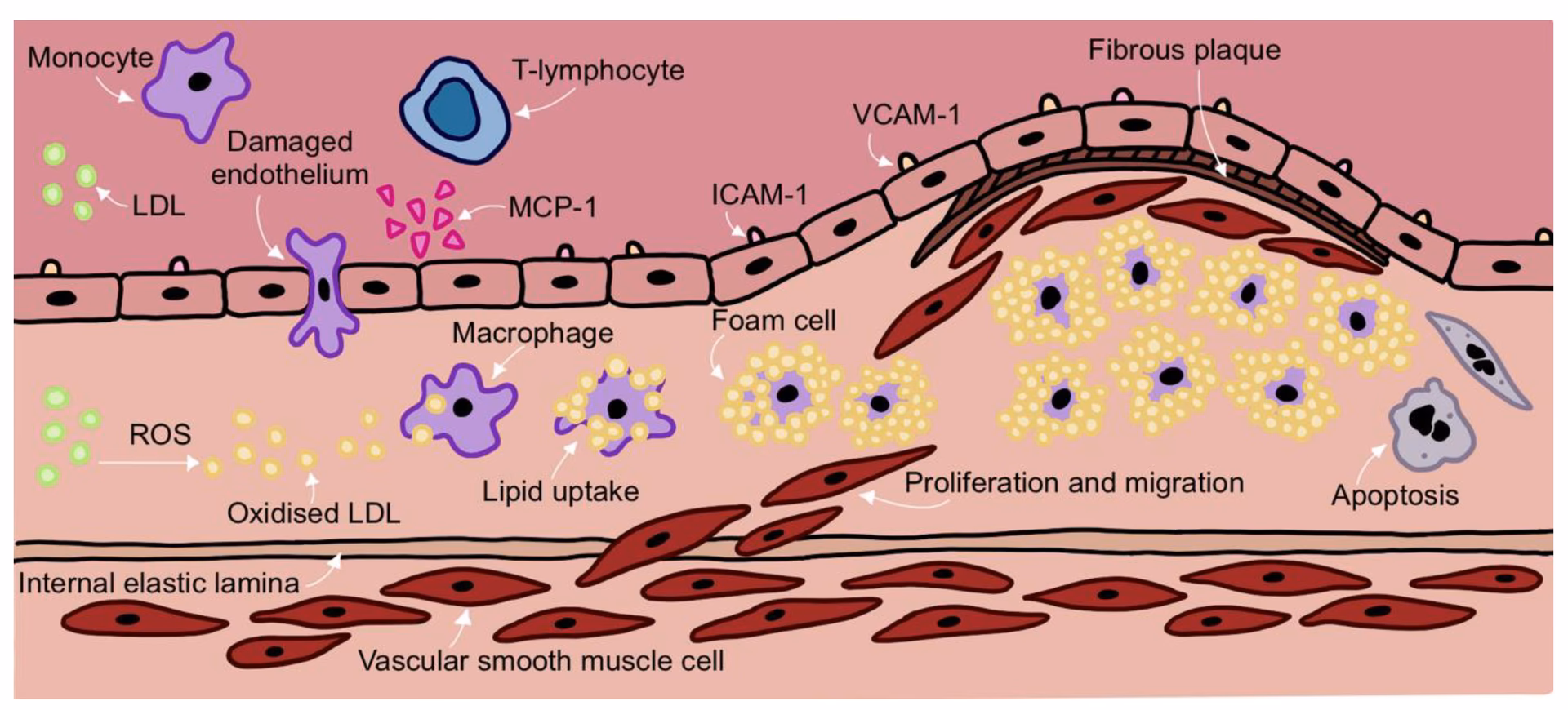 Can antioxidants reduce the progression of atherosclerosis?