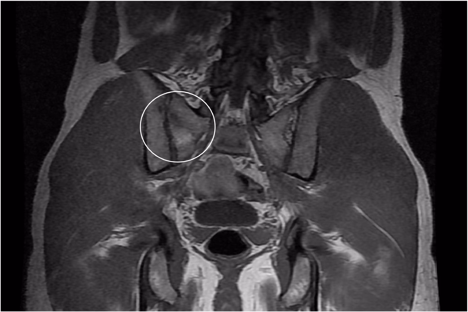 What is a sacral fatigue fracture?