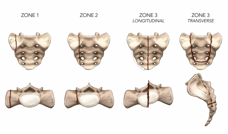 How is a sacrum stress fracture diagnosed?