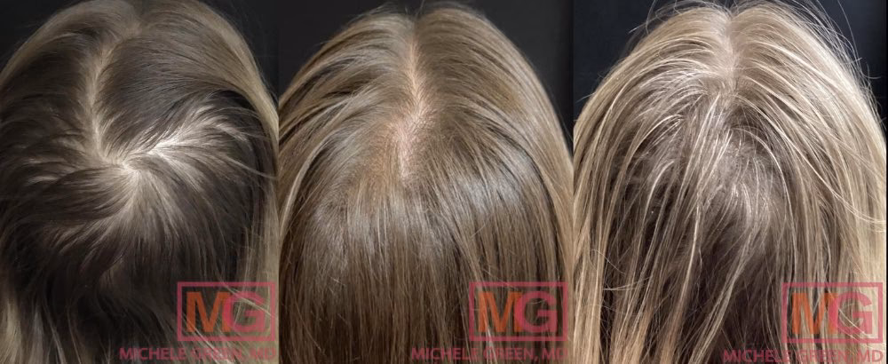Are men more prone to hair loss than women?