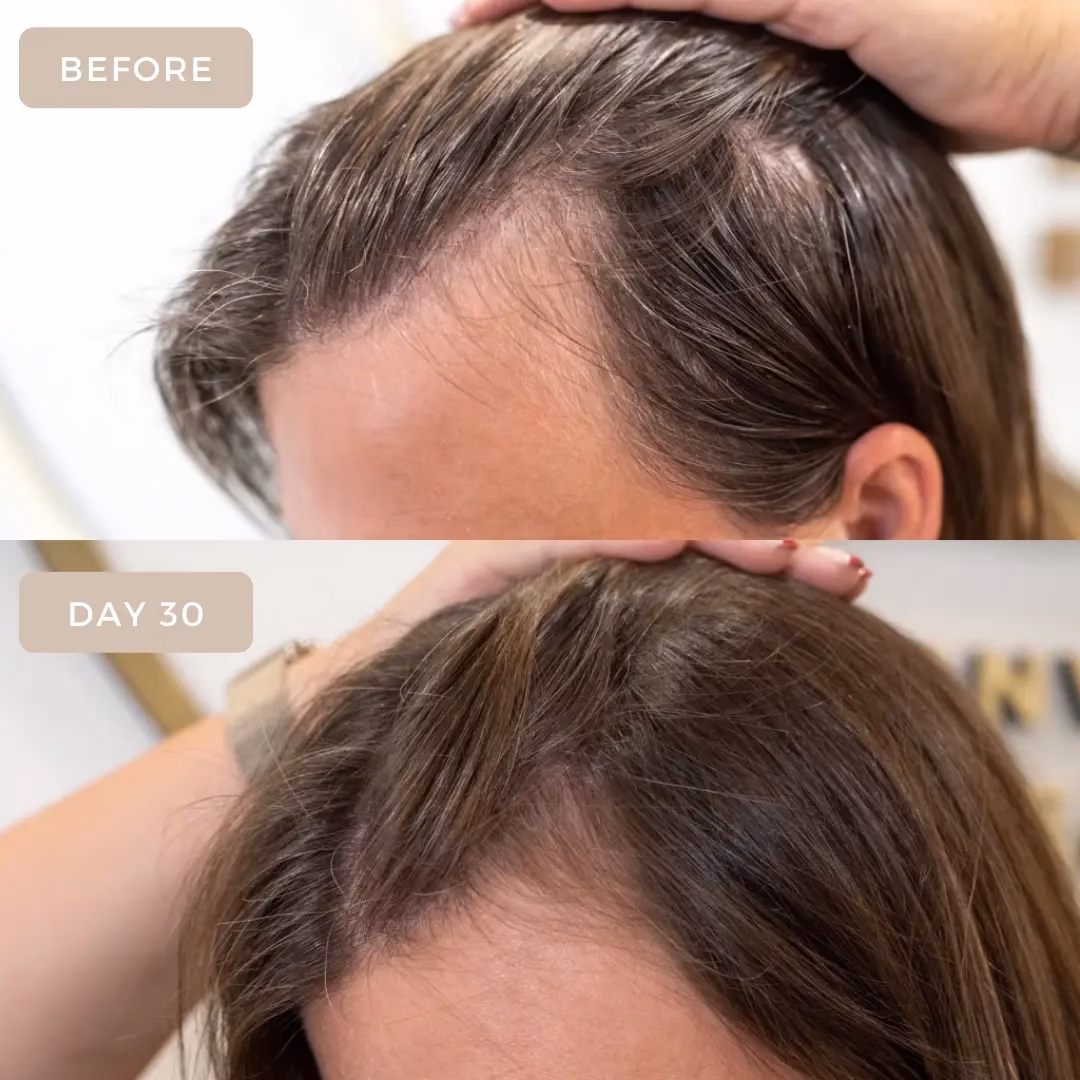 Is there a treatment for stress-related hair loss?
