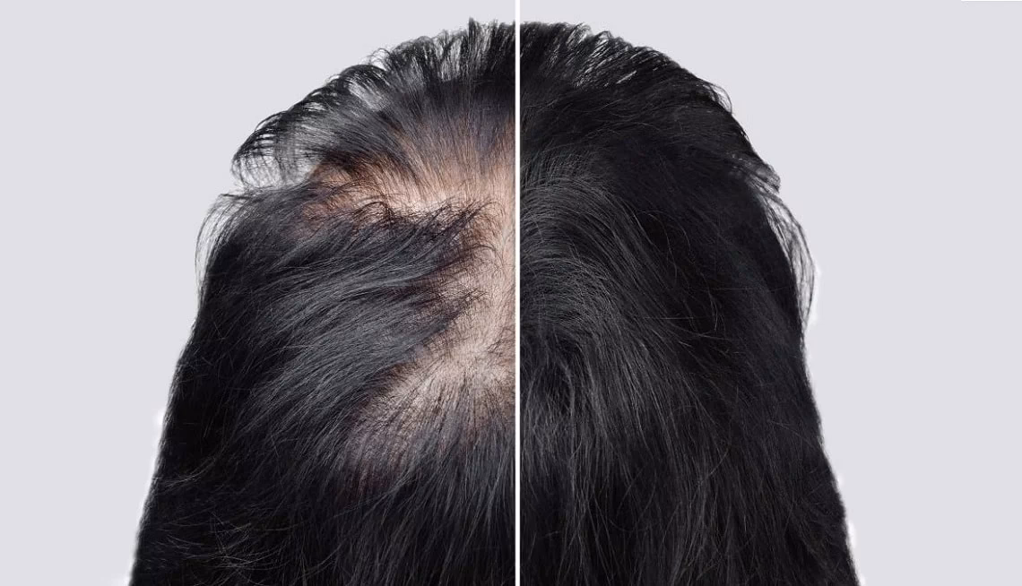 How does stress affect the hair follicle?