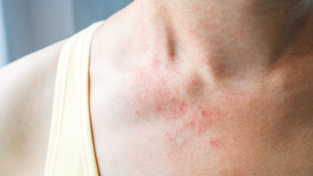 Pourquoi j'ai des boutons sur le cou ?
