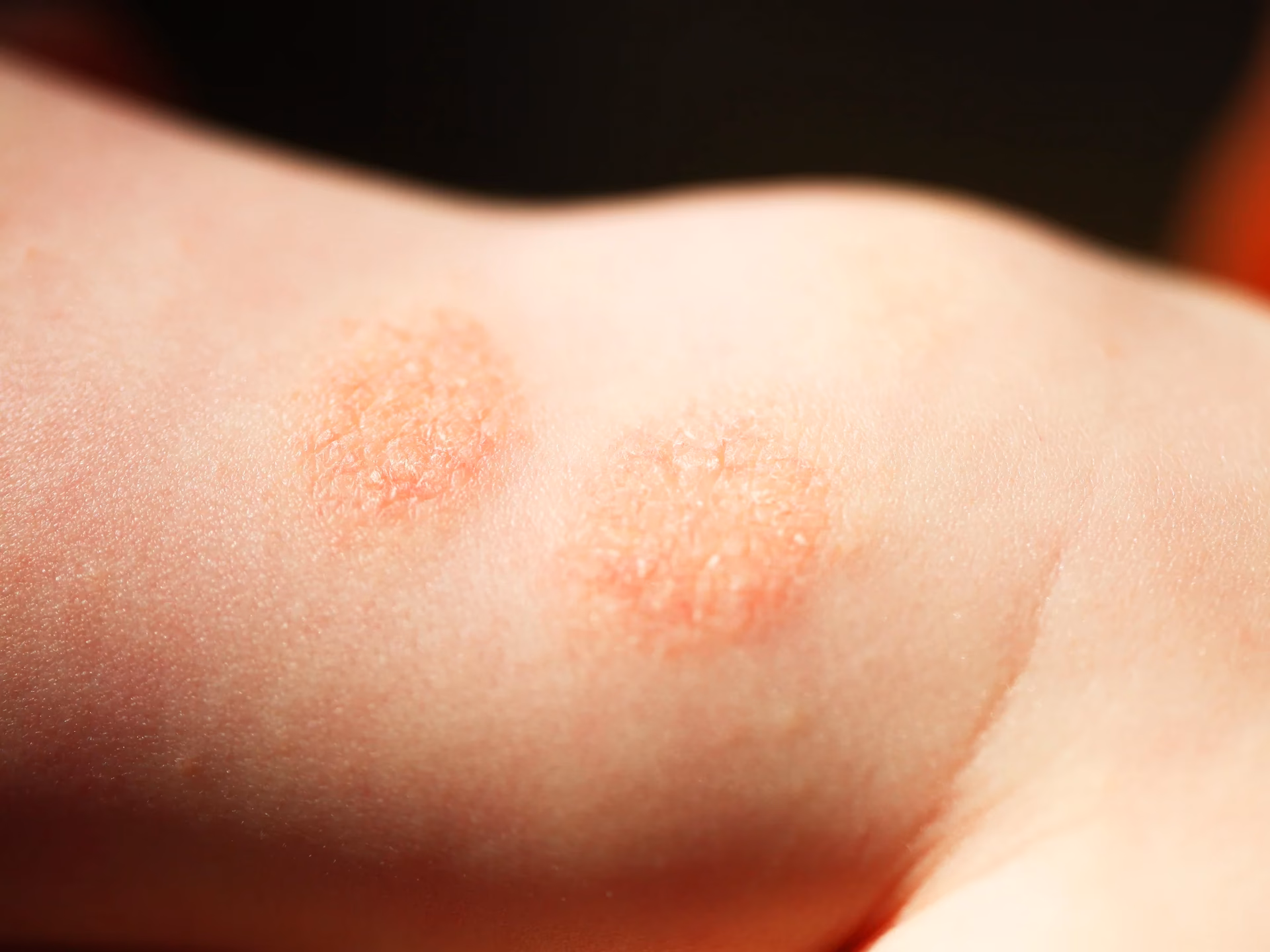 Can stress help eczema flare-ups?