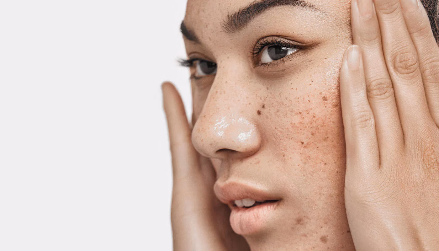 What causes hyperpigmentation?