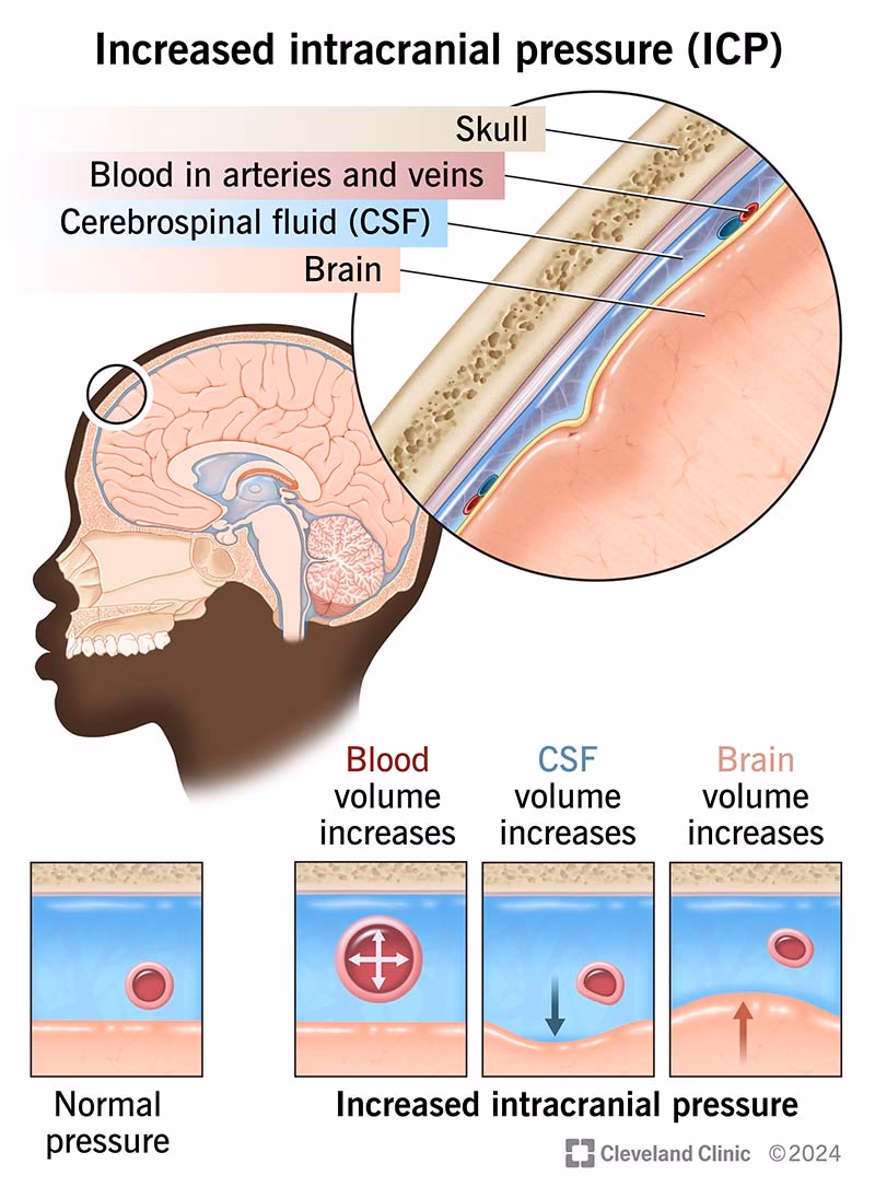 Can high intracranial pressure cause a brain herniate?