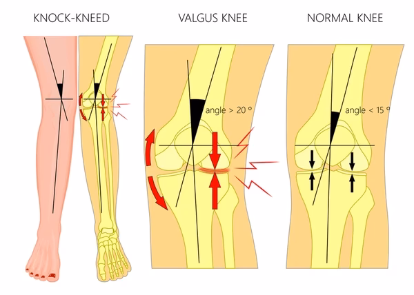 What happens if a varus stress test is positive?