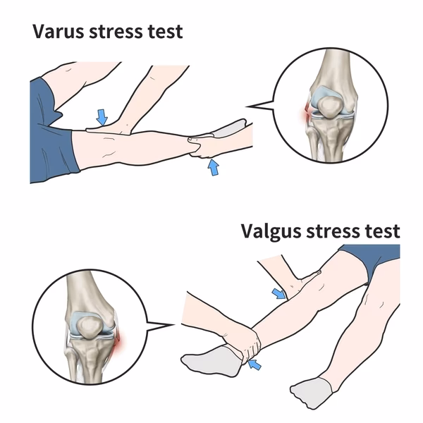 What causes abnormal valgus stress test results?